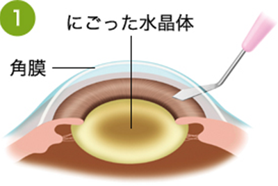 日帰り白内障手術